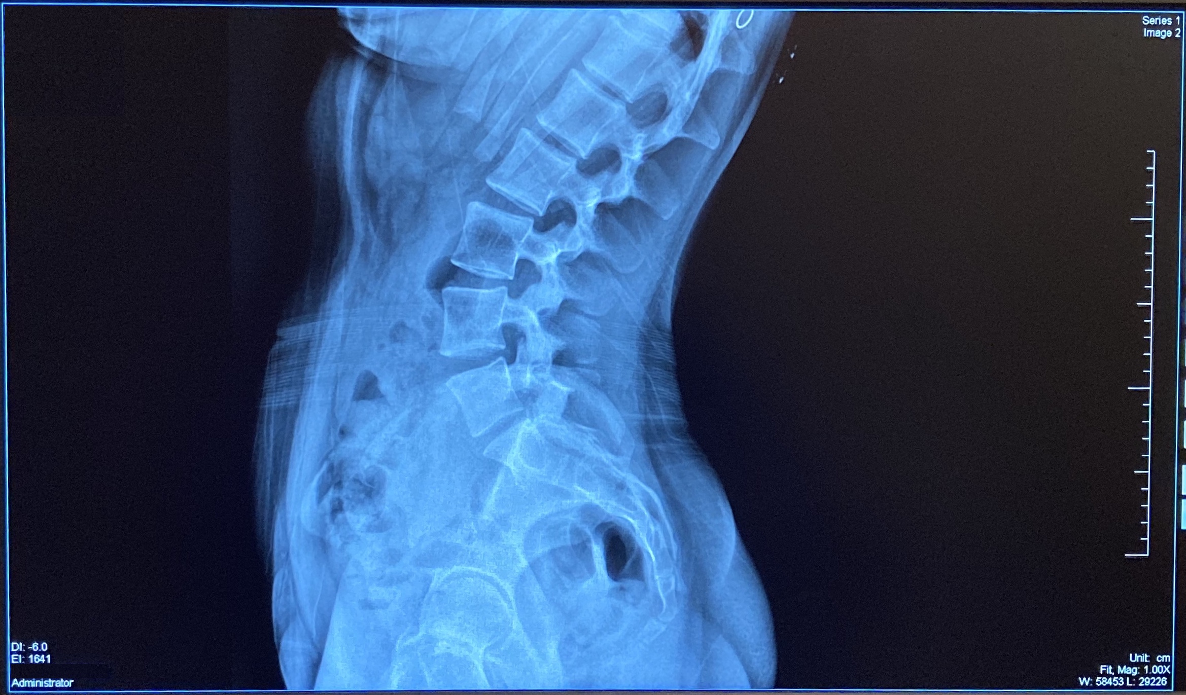 Digital X-Ray imaging technology showing crystal clear spine imagery - X-Ray Atlanta